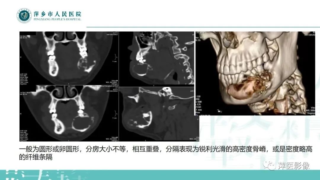 影像PPT - 【PPT】浅谈颌骨常见囊性病变-23