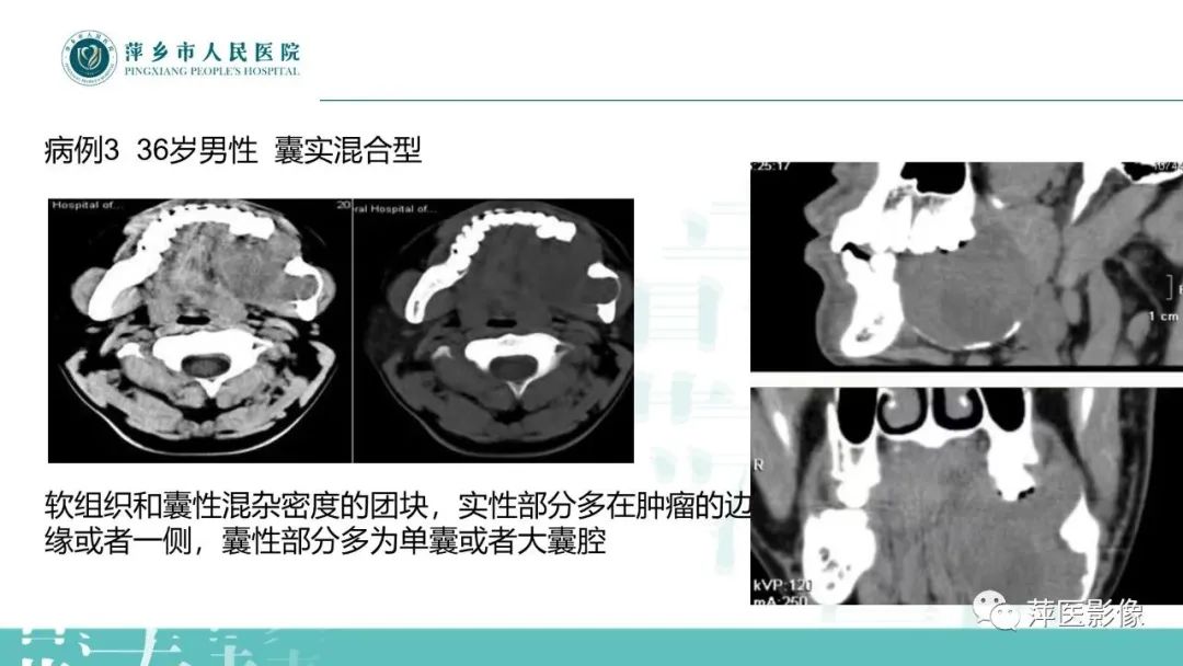 影像PPT - 【PPT】浅谈颌骨常见囊性病变-24