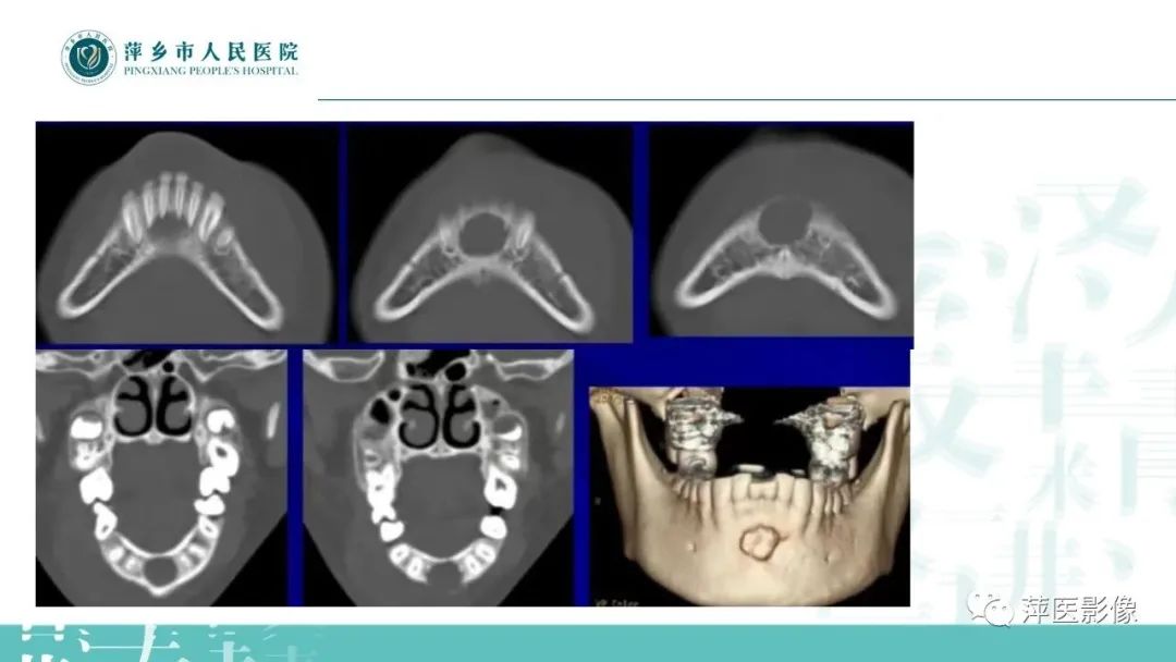 影像PPT - 【PPT】浅谈颌骨常见囊性病变-26