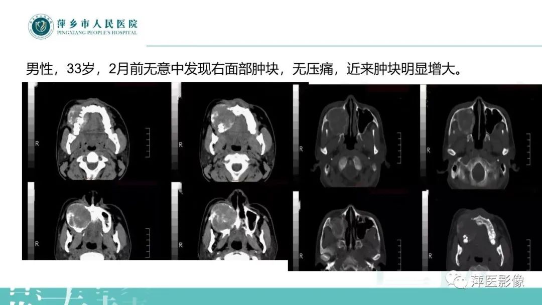 影像PPT - 【PPT】浅谈颌骨常见囊性病变-29