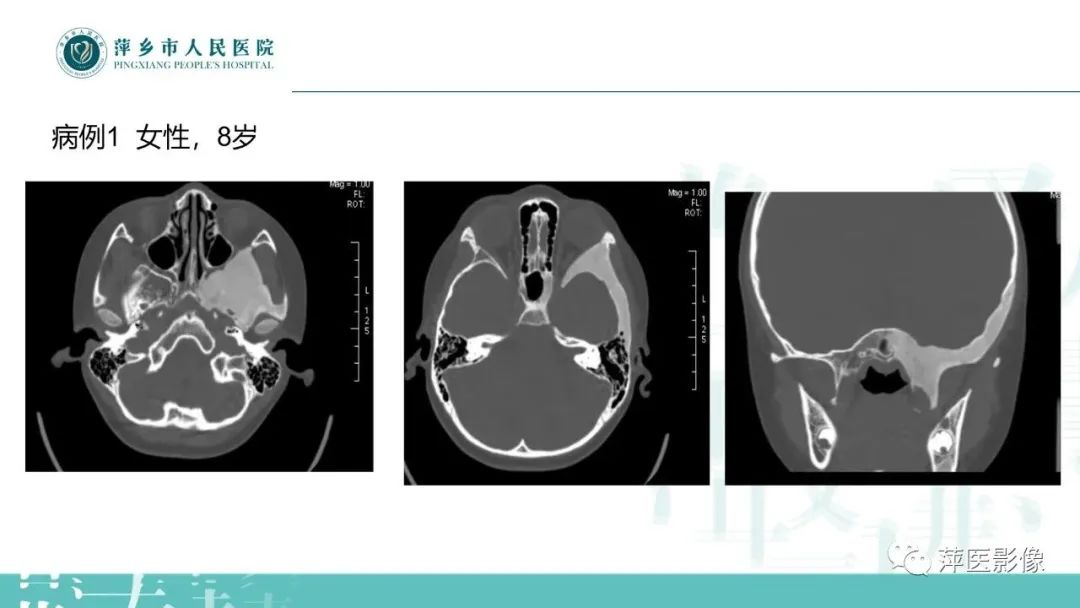 影像PPT - 【PPT】浅谈颌骨常见囊性病变-32