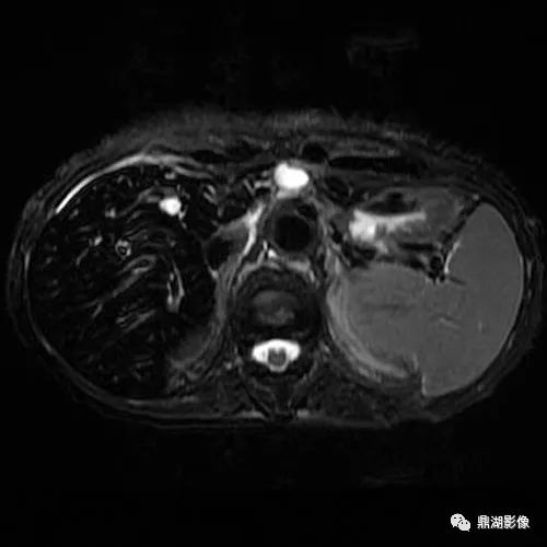 影像PPT - 血色病（血色素沉着症，hemachromatosis)-2