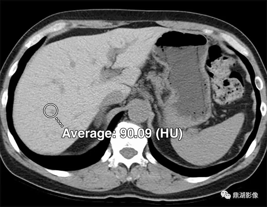 影像PPT - 血色病（血色素沉着症，hemachromatosis)-1