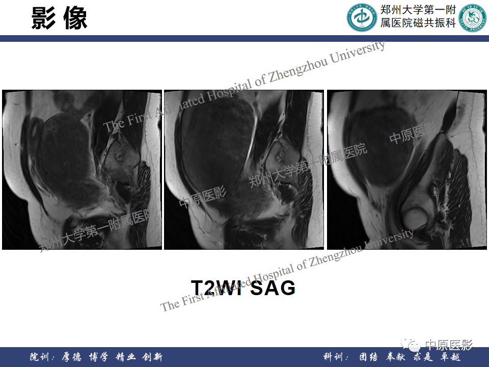 影像PPT - 【病例】子宫肌瘤1例MR影像-6