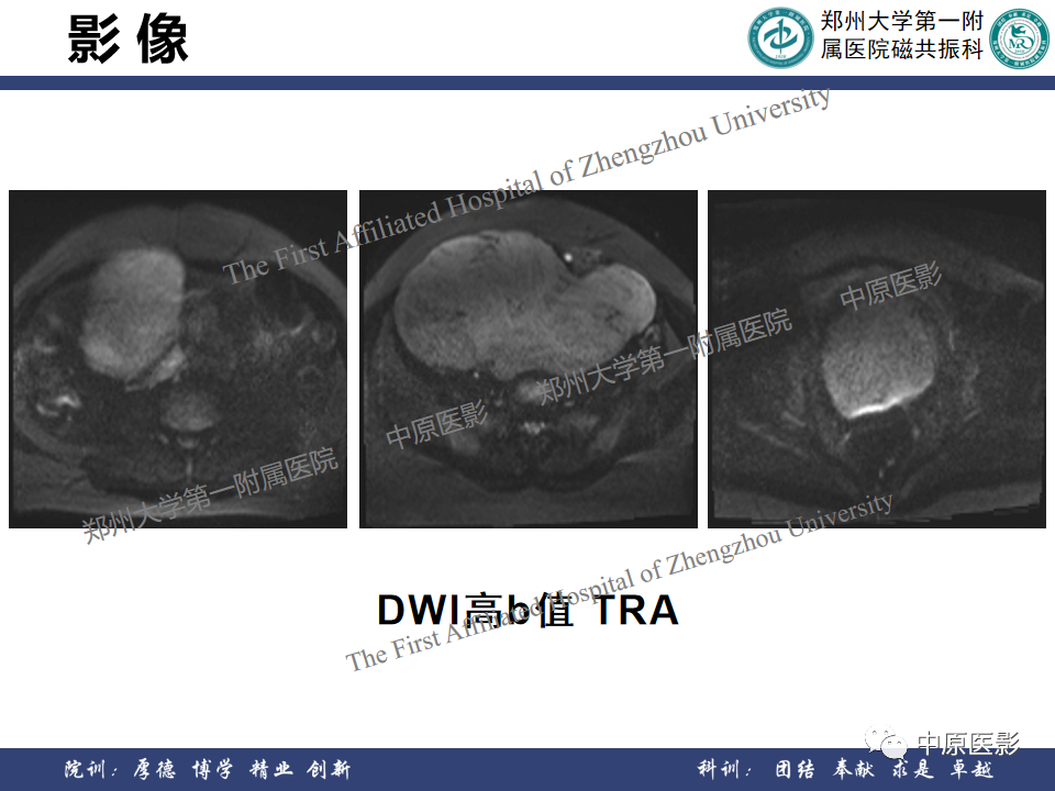 影像PPT - 【病例】子宫肌瘤1例MR影像-7