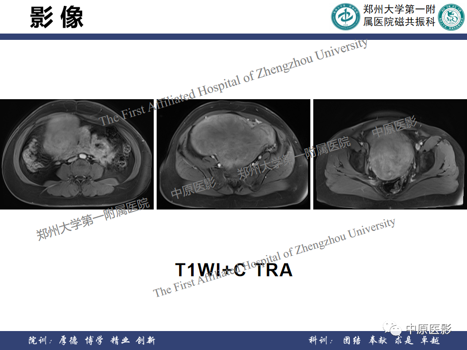 影像PPT - 【病例】子宫肌瘤1例MR影像-9