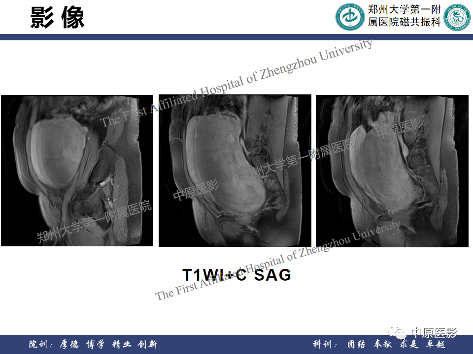 影像PPT - 【病例】子宫肌瘤1例MR影像-10
