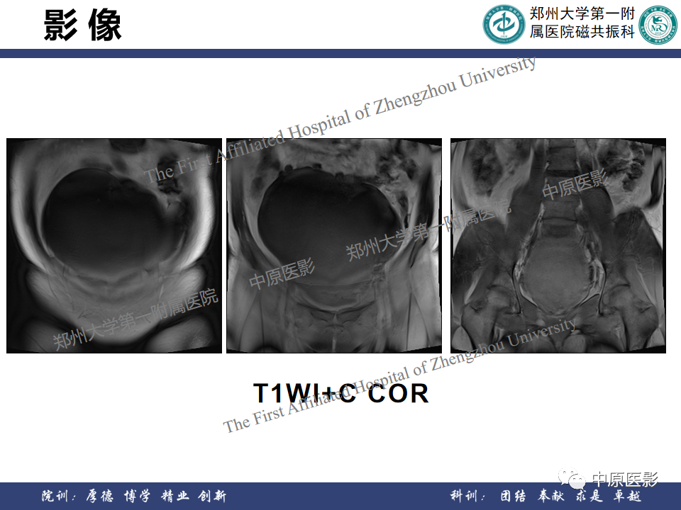影像PPT - 【病例】子宫肌瘤1例MR影像-11