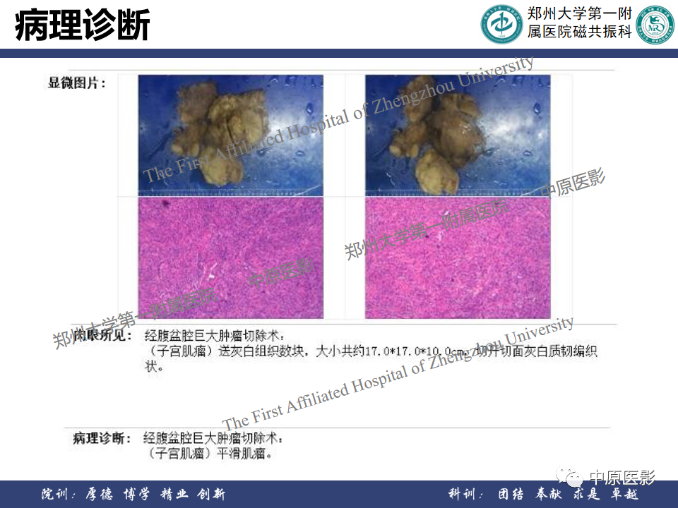 影像PPT - 【病例】子宫肌瘤1例MR影像-14