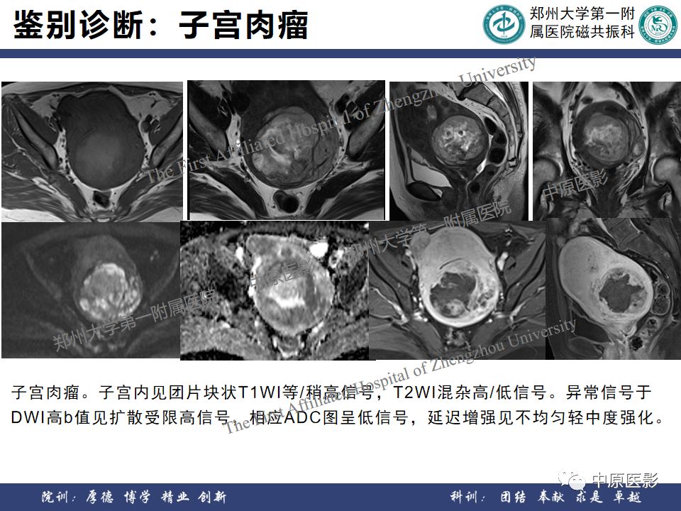 影像PPT - 【病例】子宫肌瘤1例MR影像-19