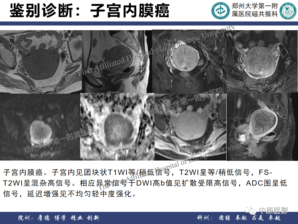 影像PPT - 【病例】子宫肌瘤1例MR影像-22