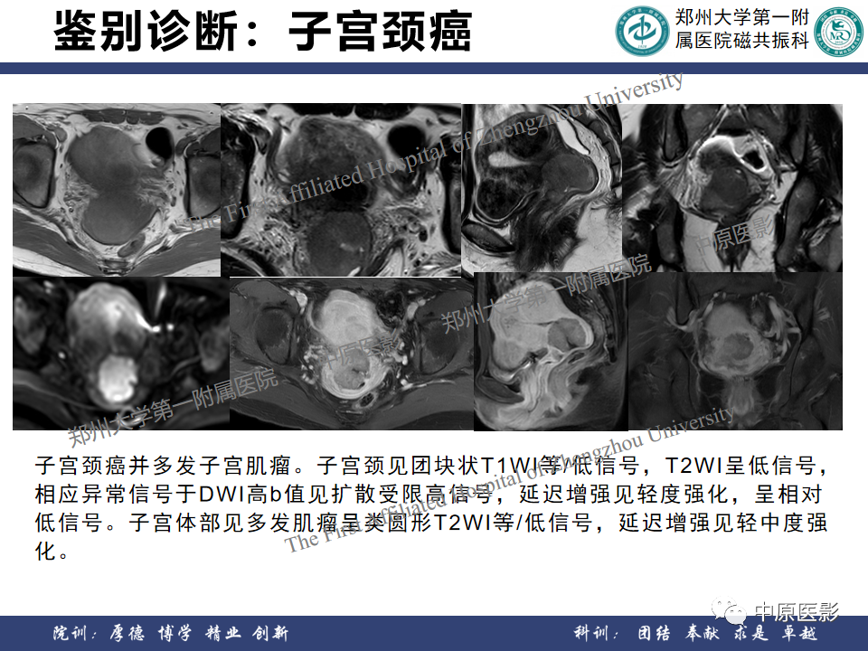影像PPT - 【病例】子宫肌瘤1例MR影像-25