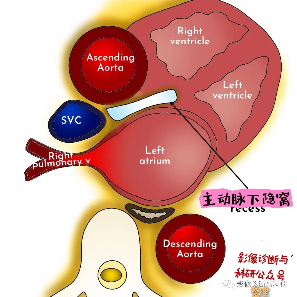 影像PPT - 心包隐窝-5 影像PPT - 心包隐窝-5