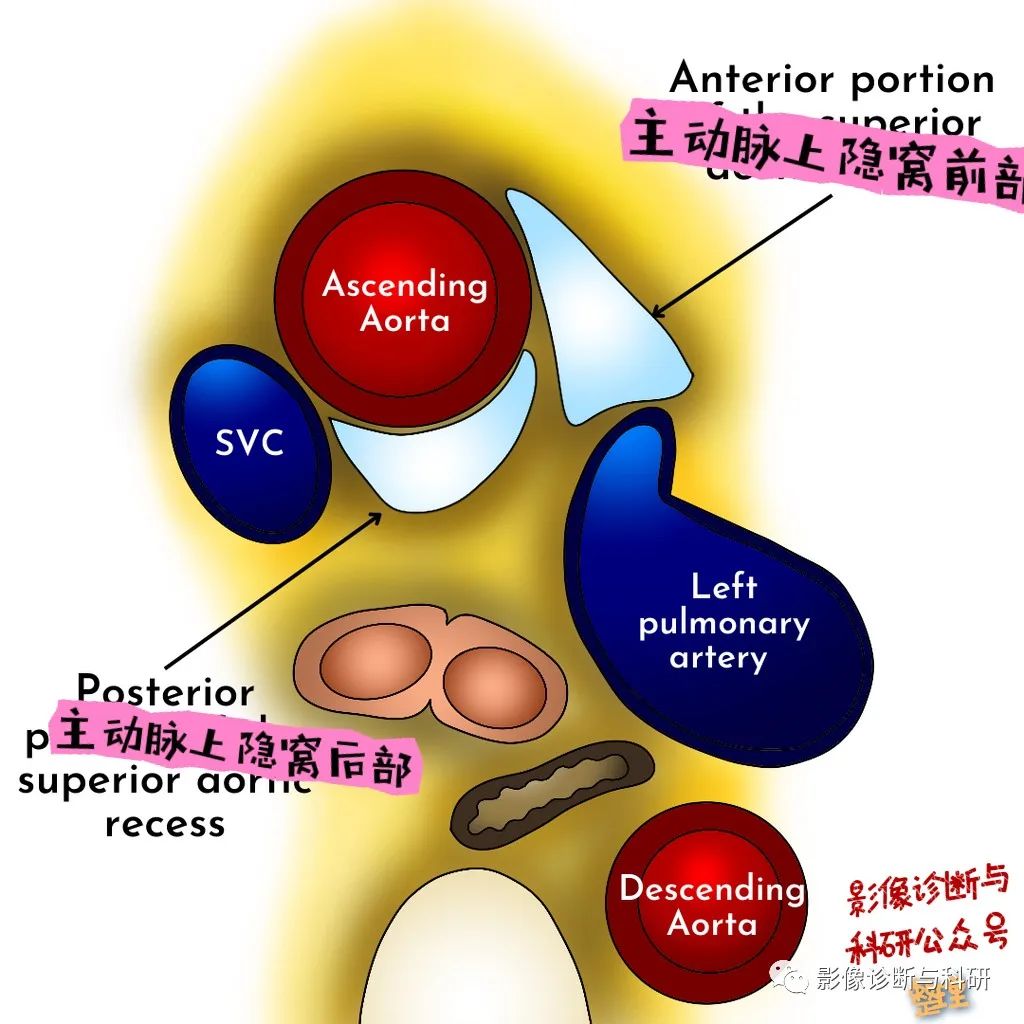 影像PPT - 心包隐窝-2 影像PPT - 心包隐窝-2