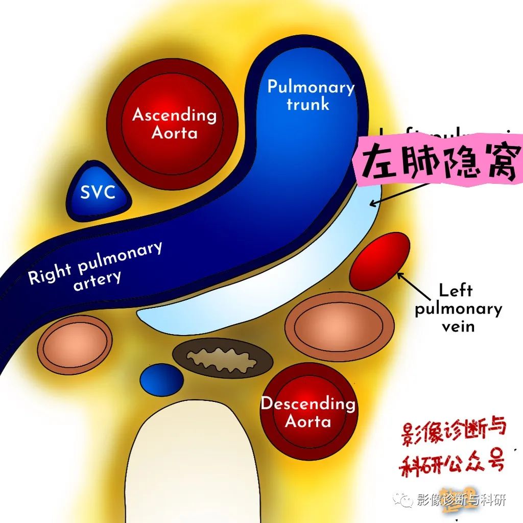 影像PPT - 心包隐窝-8 影像PPT - 心包隐窝-8