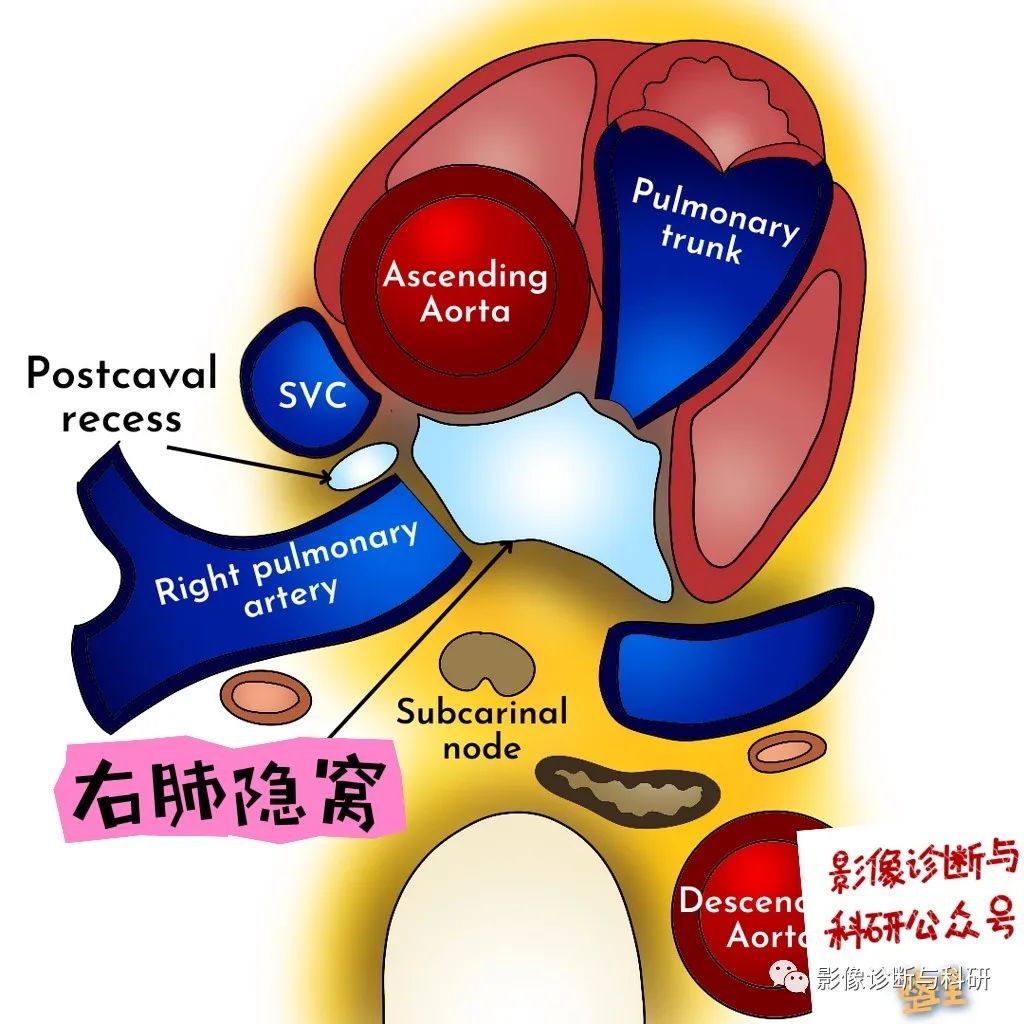 影像PPT - 心包隐窝-9 影像PPT - 心包隐窝-9