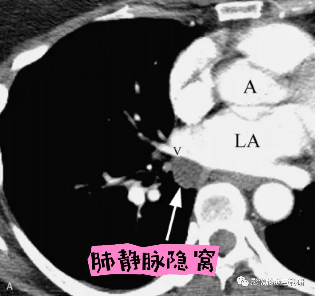 影像PPT - 心包隐窝-10 影像PPT - 心包隐窝-10