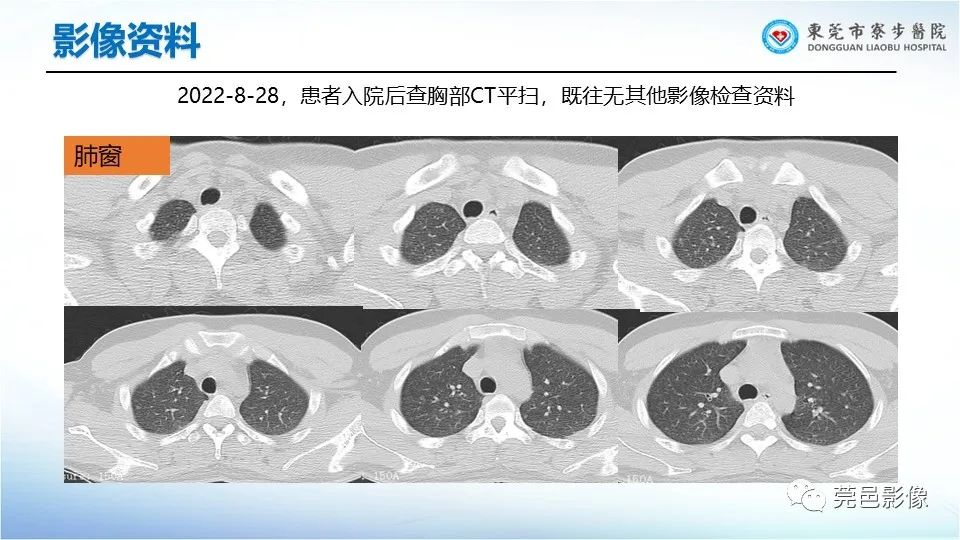影像PPT - 【PPT】一例结节性硬化的胸部罕见病变分享-4