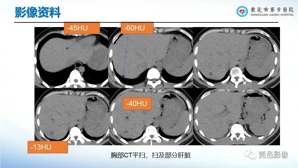 影像PPT - 【PPT】一例结节性硬化的胸部罕见病变分享-8