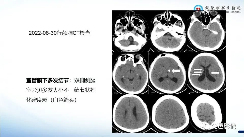 影像PPT - 【PPT】一例结节性硬化的胸部罕见病变分享-16