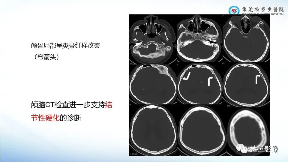 影像PPT - 【PPT】一例结节性硬化的胸部罕见病变分享-17