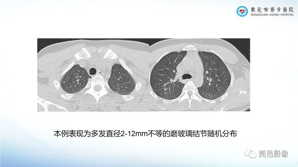 影像PPT - 【PPT】一例结节性硬化的胸部罕见病变分享-22