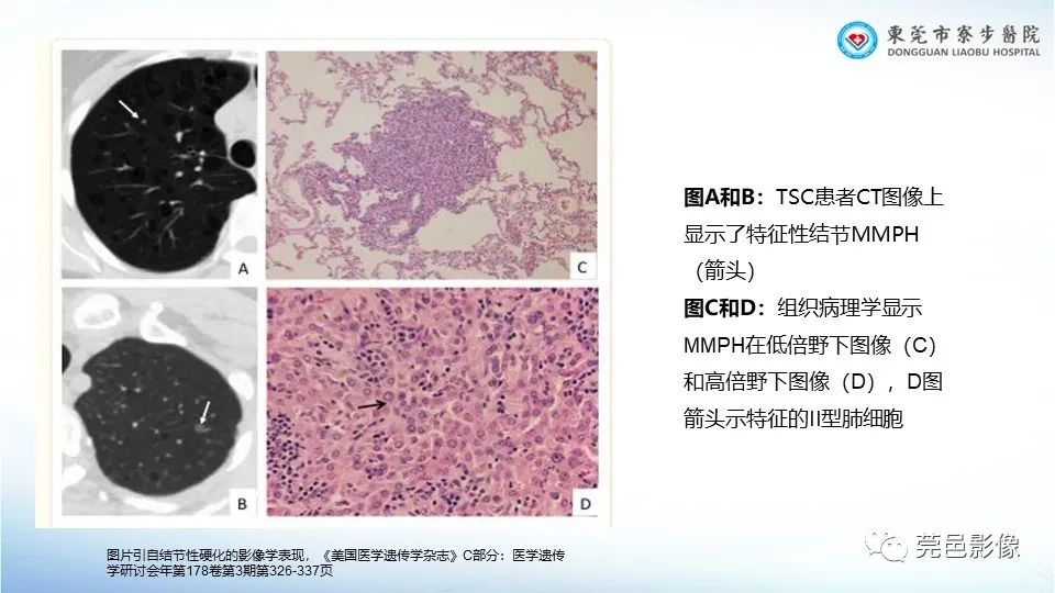 影像PPT - 【PPT】一例结节性硬化的胸部罕见病变分享-23