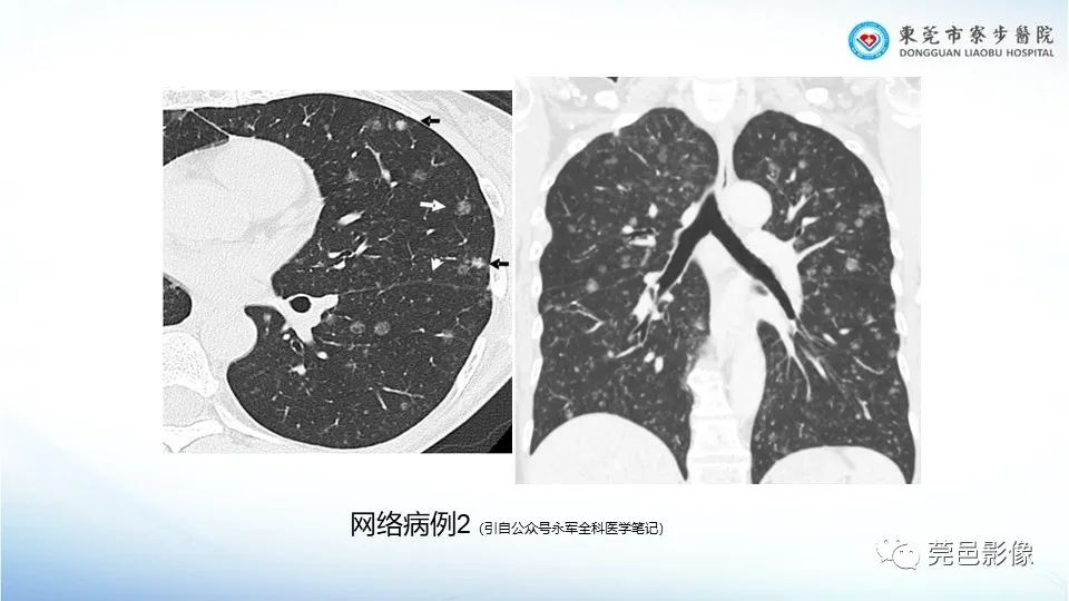 影像PPT - 【PPT】一例结节性硬化的胸部罕见病变分享-25