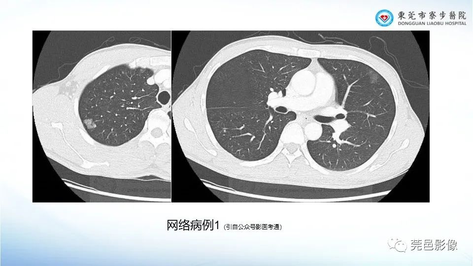 影像PPT - 【PPT】一例结节性硬化的胸部罕见病变分享-24