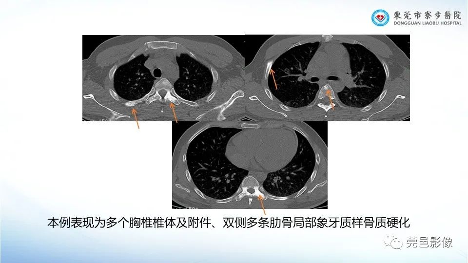影像PPT - 【PPT】一例结节性硬化的胸部罕见病变分享-27