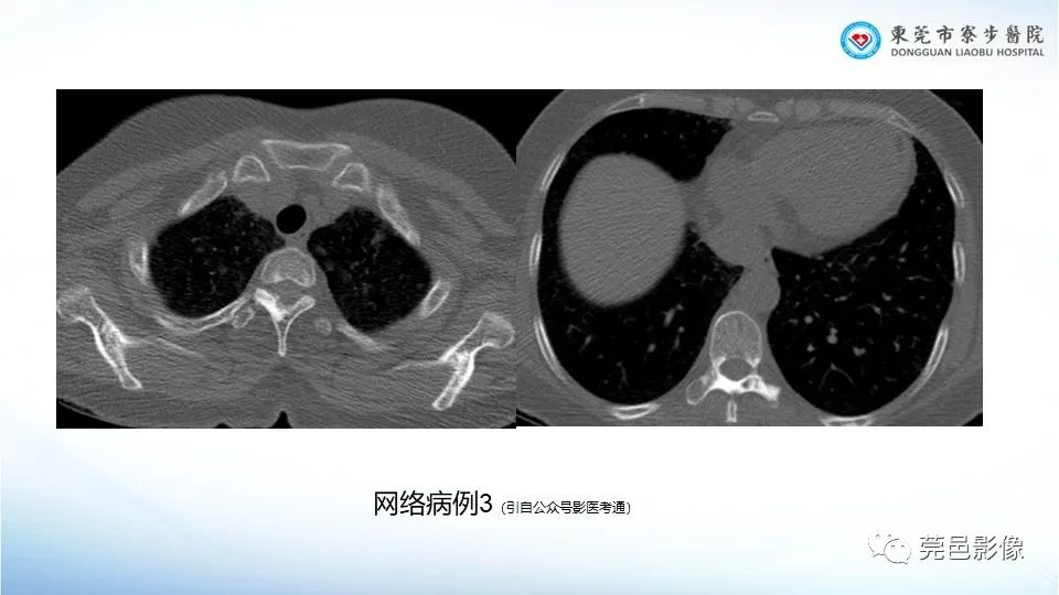 影像PPT - 【PPT】一例结节性硬化的胸部罕见病变分享-28