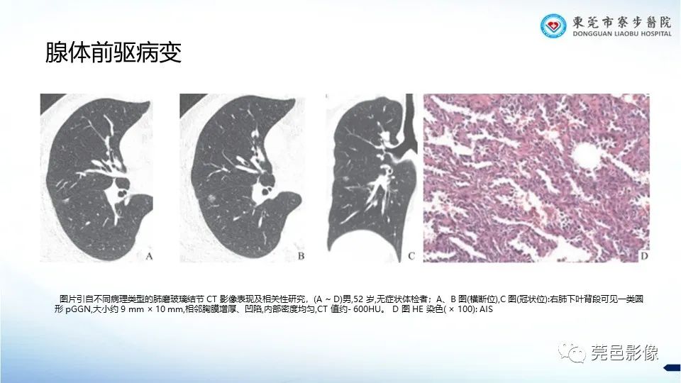 影像PPT - 【PPT】一例结节性硬化的胸部罕见病变分享-30