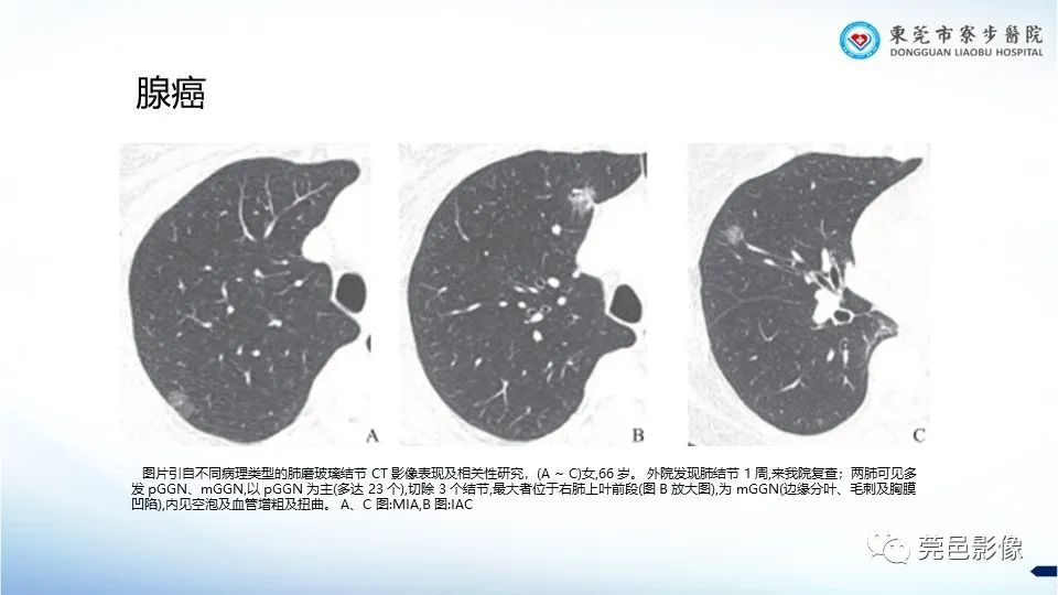 影像PPT - 【PPT】一例结节性硬化的胸部罕见病变分享-31