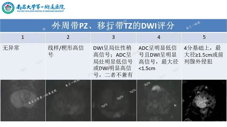 影像PPT - 【PPT】前列腺影像报告和数据系统 PI-RADS V2.1-12