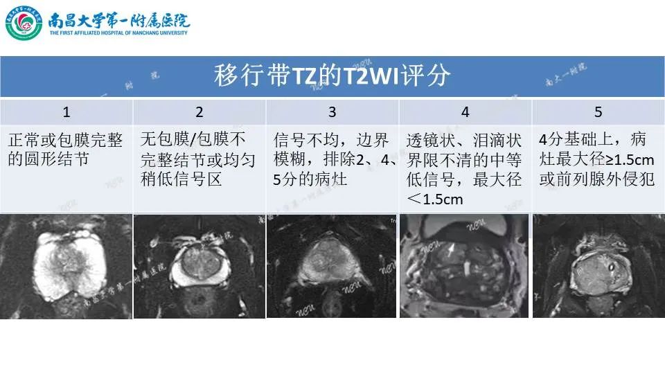 影像PPT - 【PPT】前列腺影像报告和数据系统 PI-RADS V2.1-13