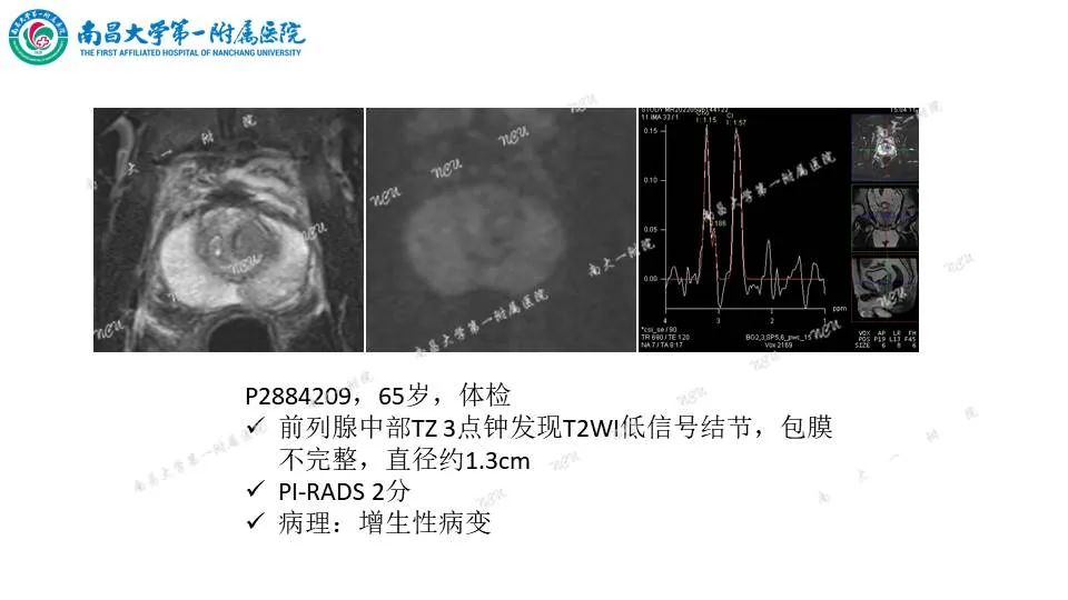 影像PPT - 【PPT】前列腺影像报告和数据系统 PI-RADS V2.1-15