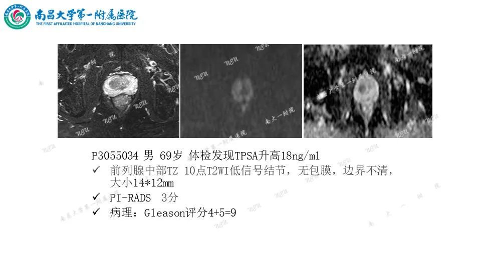 影像PPT - 【PPT】前列腺影像报告和数据系统 PI-RADS V2.1-16