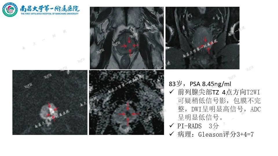 影像PPT - 【PPT】前列腺影像报告和数据系统 PI-RADS V2.1-18