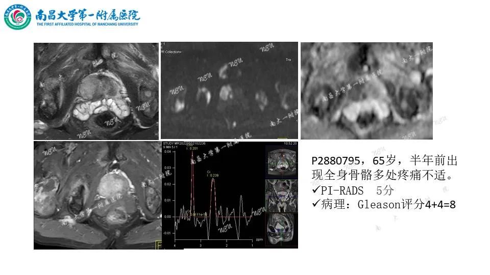 影像PPT - 【PPT】前列腺影像报告和数据系统 PI-RADS V2.1-20