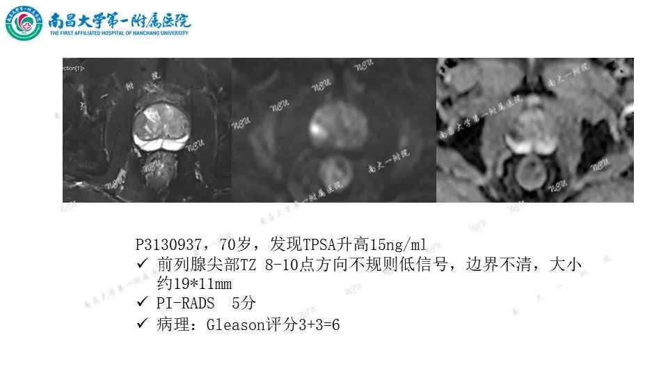 影像PPT - 【PPT】前列腺影像报告和数据系统 PI-RADS V2.1-19
