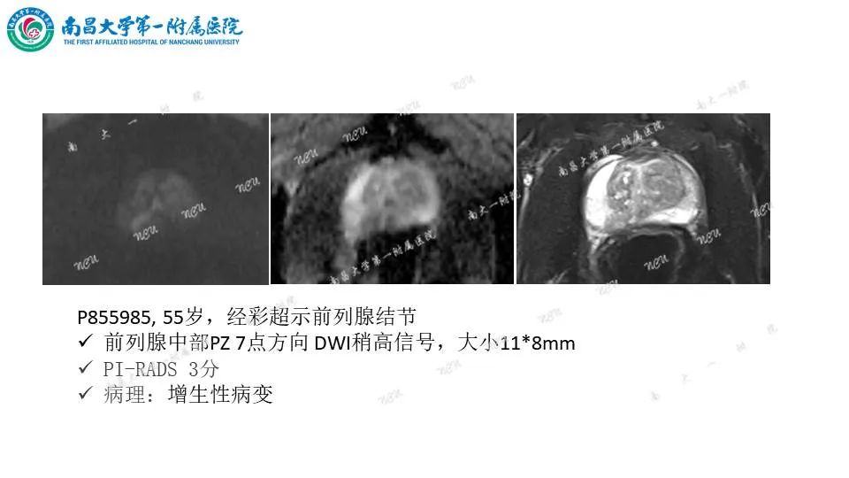 影像PPT - 【PPT】前列腺影像报告和数据系统 PI-RADS V2.1-22