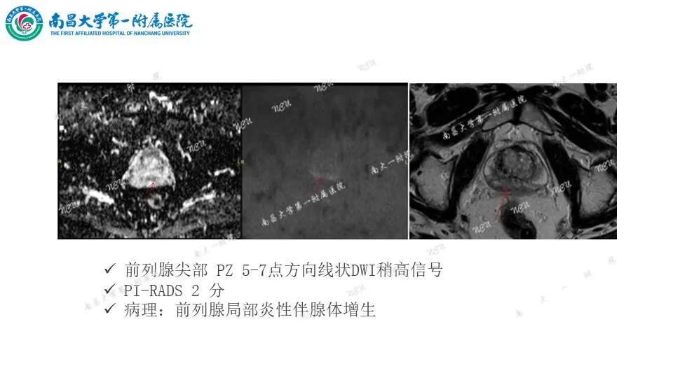 影像PPT - 【PPT】前列腺影像报告和数据系统 PI-RADS V2.1-21