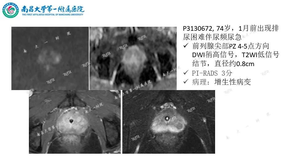 影像PPT - 【PPT】前列腺影像报告和数据系统 PI-RADS V2.1-23