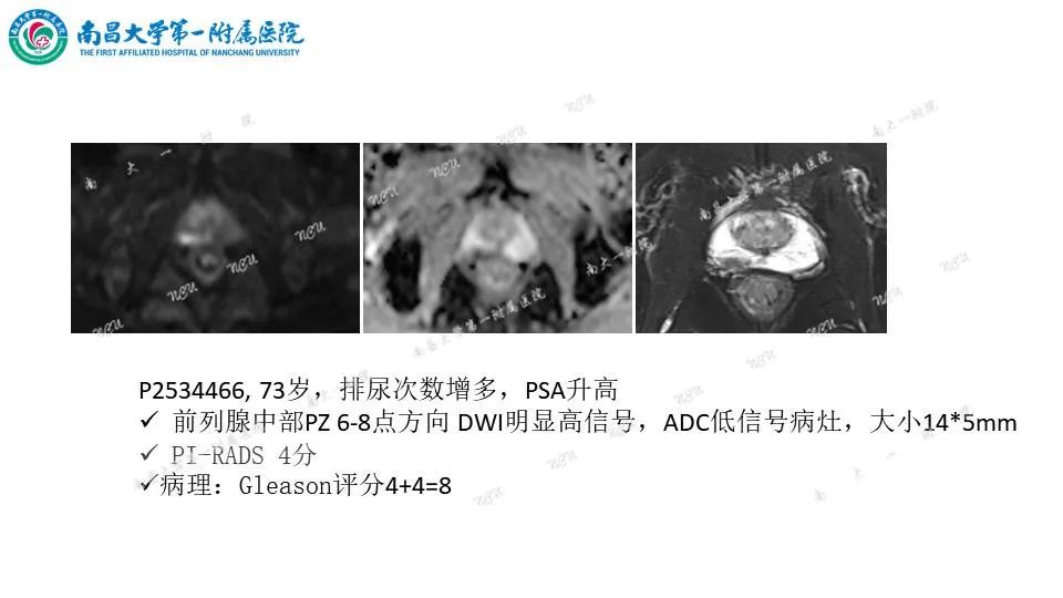 影像PPT - 【PPT】前列腺影像报告和数据系统 PI-RADS V2.1-24