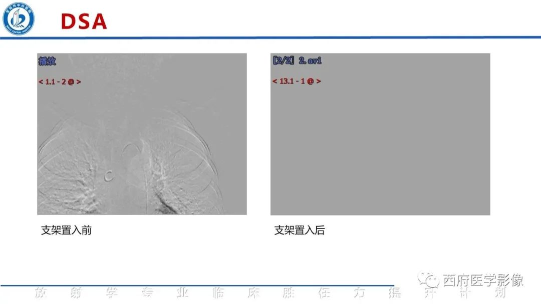 影像PPT - 【病例】锁骨下动脉盗血综合征1例CT影像-9