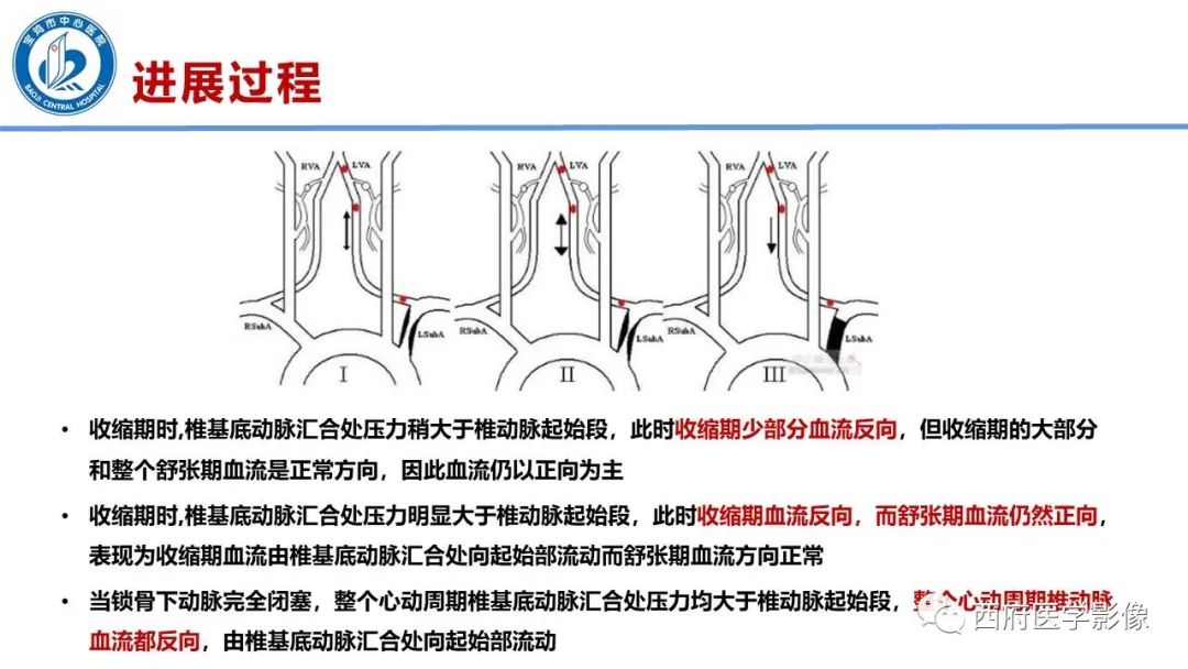 影像PPT - 【病例】锁骨下动脉盗血综合征1例CT影像-13