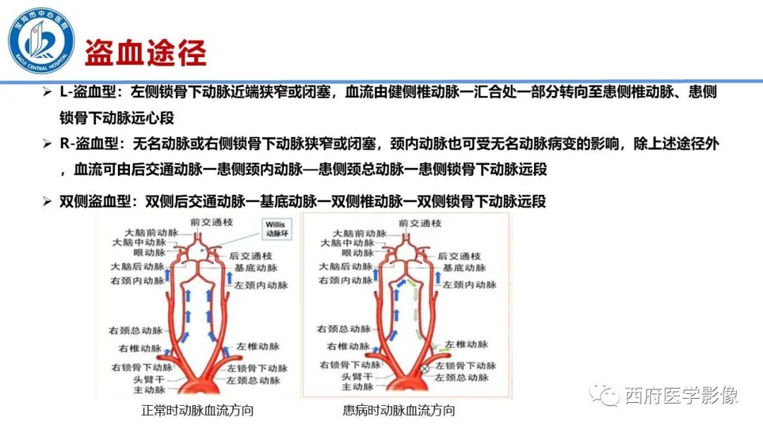 影像PPT - 【病例】锁骨下动脉盗血综合征1例CT影像-14