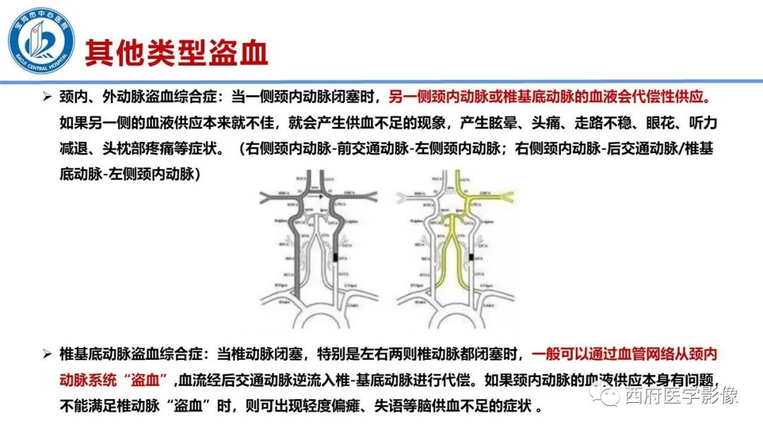 影像PPT - 【病例】锁骨下动脉盗血综合征1例CT影像-20