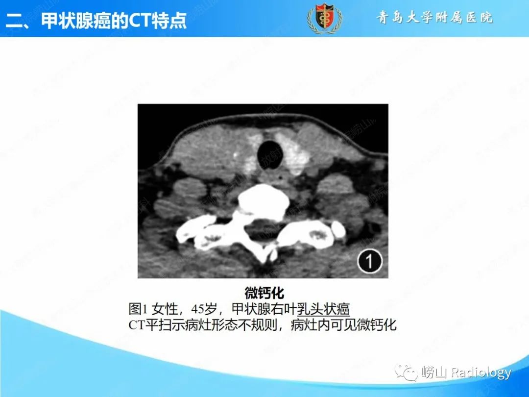 影像PPT - 【PPT】甲状腺癌及其转移淋巴结的影像诊断及鉴别诊断-8