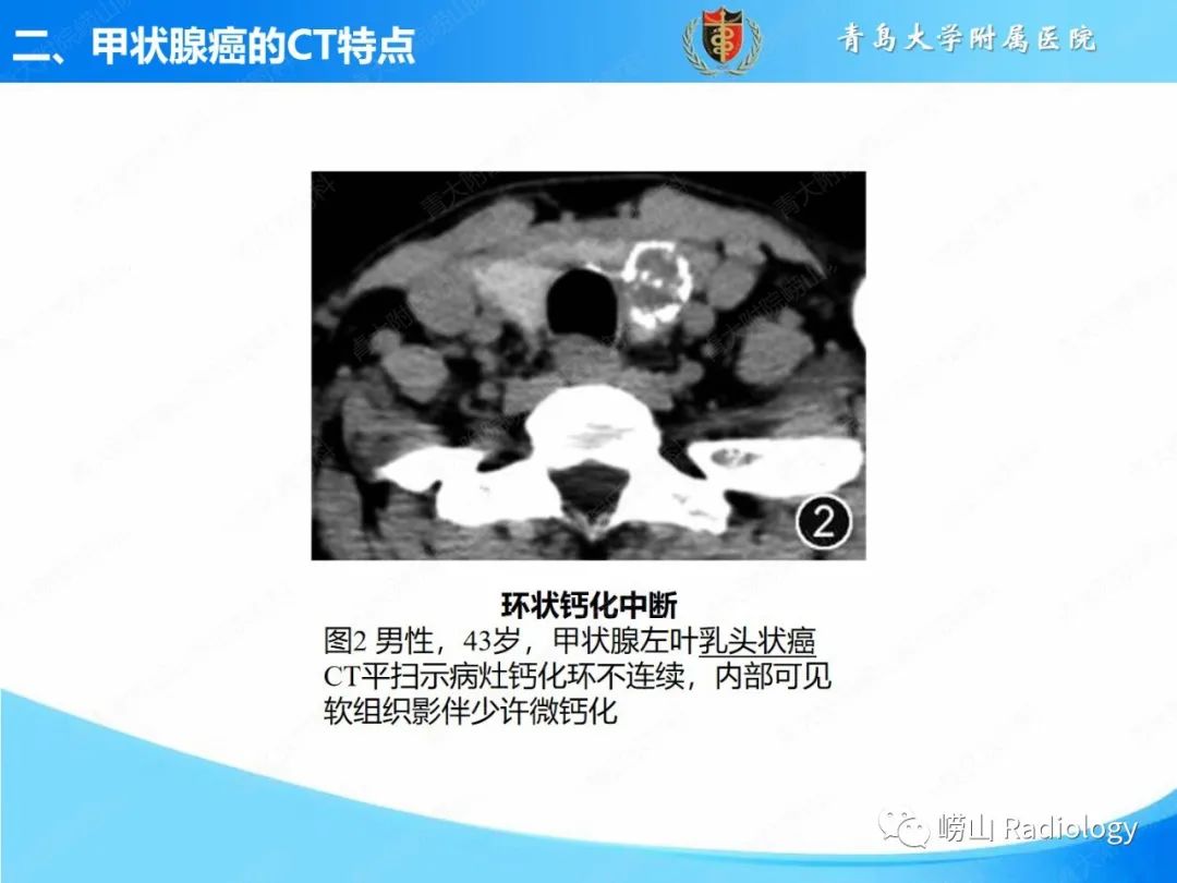 影像PPT - 【PPT】甲状腺癌及其转移淋巴结的影像诊断及鉴别诊断-9